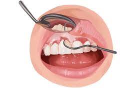 جلوگیری از التهاب لثه با جرمگیری دندان